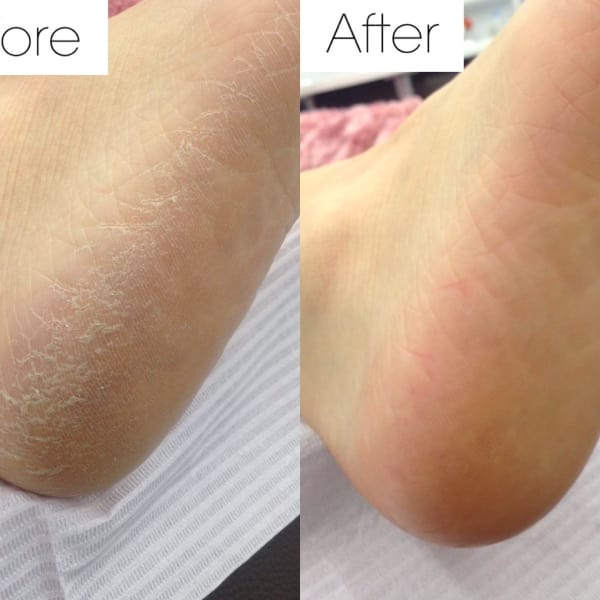 ドイツ式フットケア☆足裏の角質ケアです♪|ネイルサロンAmour 田町