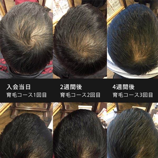 育毛を頑張ったけど生えなかった方の為の本気育毛コース！|くせ毛専門美容室ヘアエステ ウィルミナ