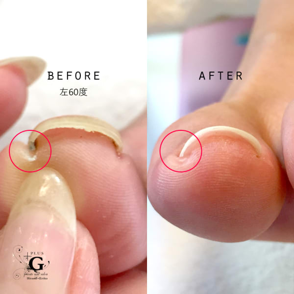 【初回ケア代￥1500/１本無料】痛くない巻き爪補正ペディグラス★着けた直後から効果を実感|plusG