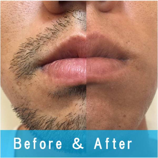 Men's Salon.ZERO心斎橋【お客様脱毛写真】|Men's Salon ZERO心斎橋店