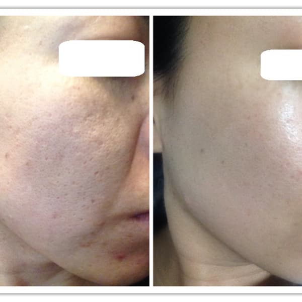 肌質を徹底改善！マイナス10歳肌を目指す！リベルハーブピーリング|Health Beauty Produce J.O