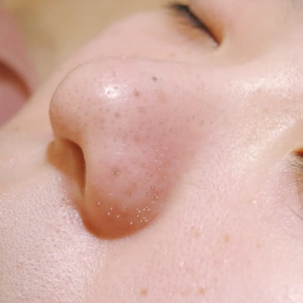 【充実・毛穴洗浄】お肌の基本づくり、気になる毛穴、ブツブツ皮脂汚れ、固くなった角質が気になる方へ|ベル ルミエール イオンモール大曲店