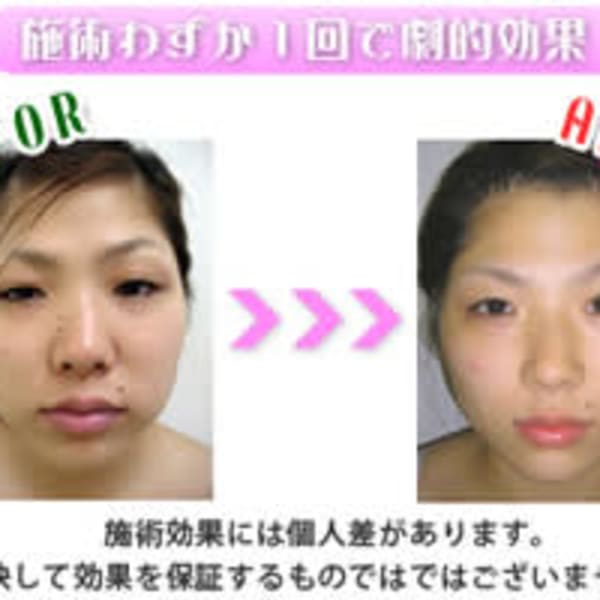 【本格美小顔フェイシャル】脂肪燃焼＆細胞を活性化しハリ・弾力・リフトUP効果◎|SPA・DOOM 南草津