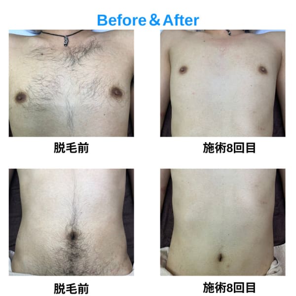 メンズビューティサロン心斎橋　【Before&After】|メンズビューティーサロン