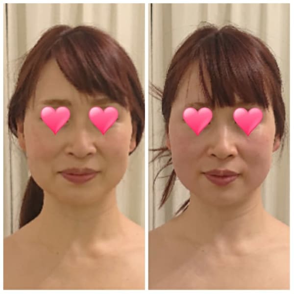 お化粧したまま小顔矯正✱30分で小顔に整えます！|ピュアエステ エルム