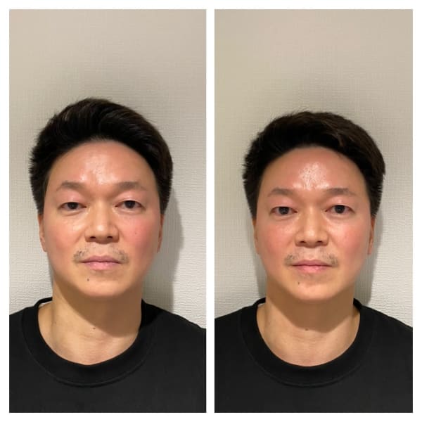 当日予約歓迎 おすすめ ハイドラフェイシャル 毛穴クレンジングで美肌力upさせましょう 脱毛 痩身 美肌 エステサロン Show 理容室併設 ダツモウ ソウシン ビハダ エステサロン ショウ のこだわり特集 エステサロンを予約するなら楽天ビューティ