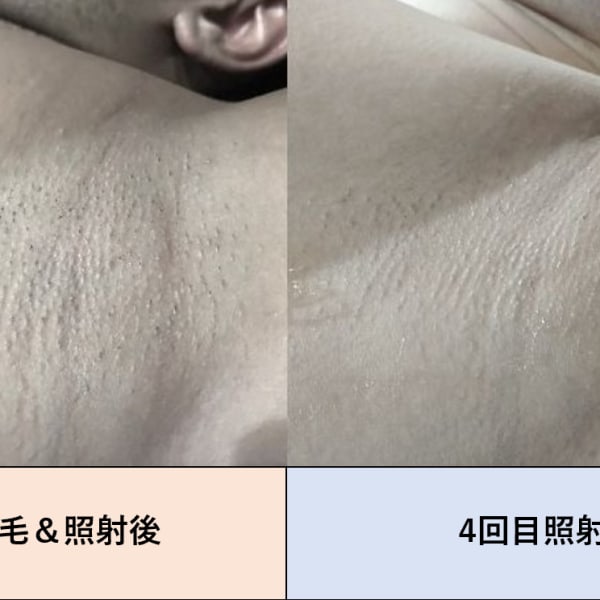剃っても毛穴が目立つ→剃らなくても生えていない状態をキープ|メンズ脱毛 R.S.Land