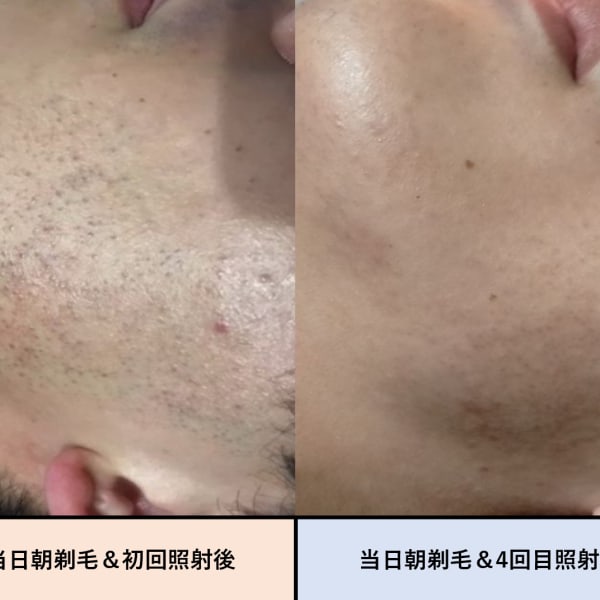 髭脱毛ならメンズ専門の脱毛サロンで!|メンズ脱毛 R.S.Land