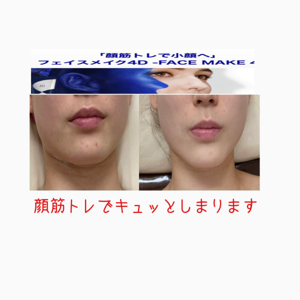 顔のプロポーションは崩れは筋肉から※個人の事例であり、効果には個人差があります　|オアシス・さくら