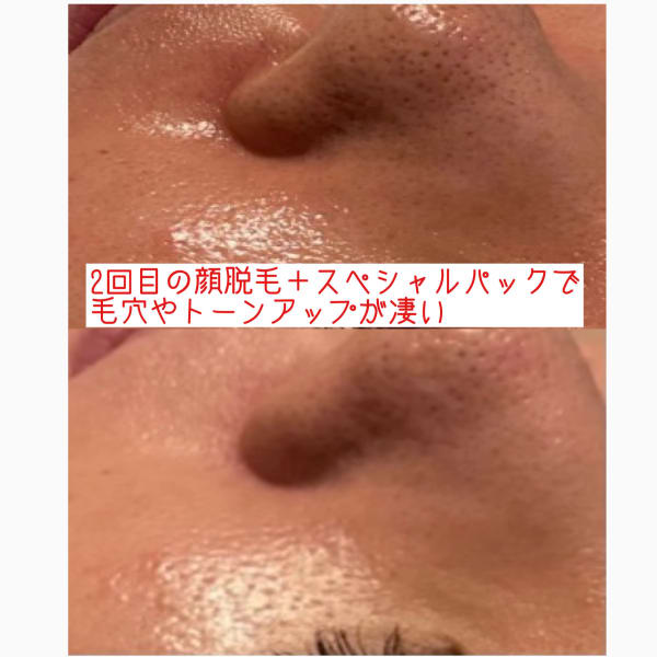 顔脱毛でお肌が美しくなります※個人の事例であり、効果には個人差があります　|オアシス・さくら