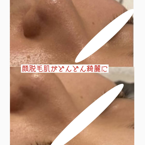 毛穴が顔脱毛で綺麗に※個人の事例であり、効果には個人差があります　|オアシス・さくら
