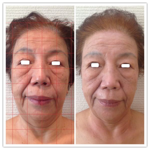 世界特許エンダモロジーと骨気小顔フェイシャル★90分24000円➡13000円|Health Beauty Produce J.O