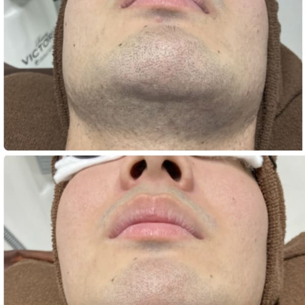 ひげ　全体しっかり脱毛　5000円|脱毛サロン CHAT