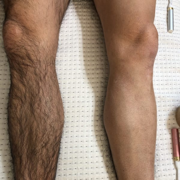 夏こそ、いま脱毛しよう。|ブランエミュ 池袋本店