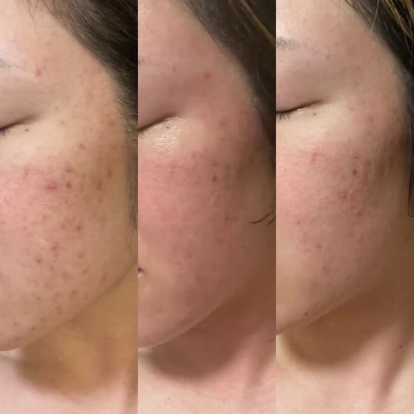 業界大注目のVOSサロンケア！最先端HARI美容でお肌の悩みを根本解決！肌細胞に刺激を与え肌を活性化|カミオ エステティック