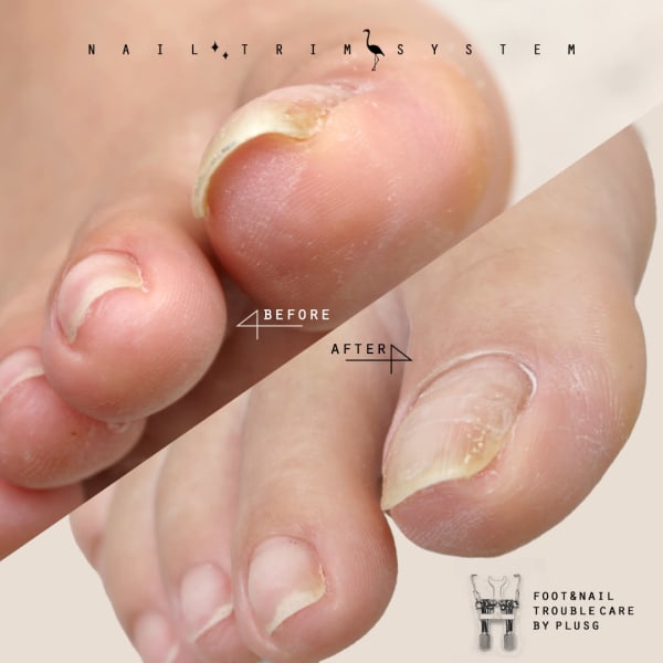 巻き爪ケアのメニューが増えました◇痛くない巻き爪補正|plusG