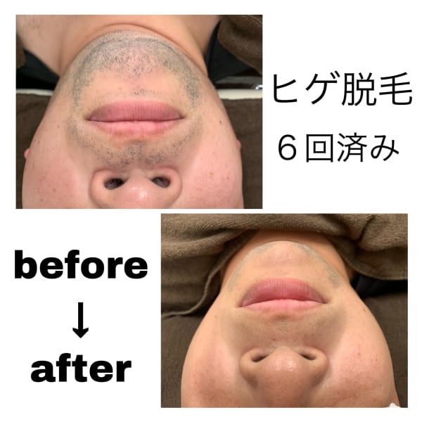 【メンズの身だしなみ＆ケアをお手伝いいたします！】|脱毛サロン KIBIK