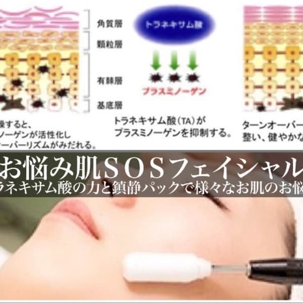 トラネキサム酸でお肌のニキビの炎症やお顔の赤み鎮静や、美白効果☆|ハーバルピール・フェイシャル/ヘッド専門 エステティックサロンJ IJ I M E N