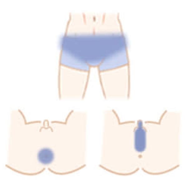 【VIO全体脱毛】デリケートゾーン脱毛が気になる方必見◎介護脱毛にも◎|メンズ脱毛サロン TRYSHIFT 柏本店