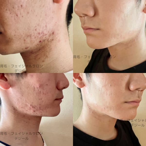 ニキビでお悩みのあなたへ!デジールは、メンズ肌のニキビケア専門サロンです【ニキビ、ニキビ跡、肌荒れ】|デジール心斎橋店