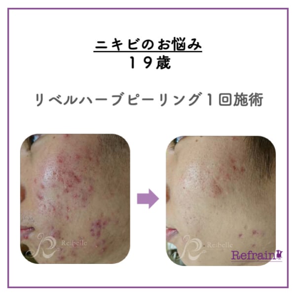 リベルハーブピーリング|メンズ脱毛・リベルハーブピーリング・毛穴洗浄【Refrain】