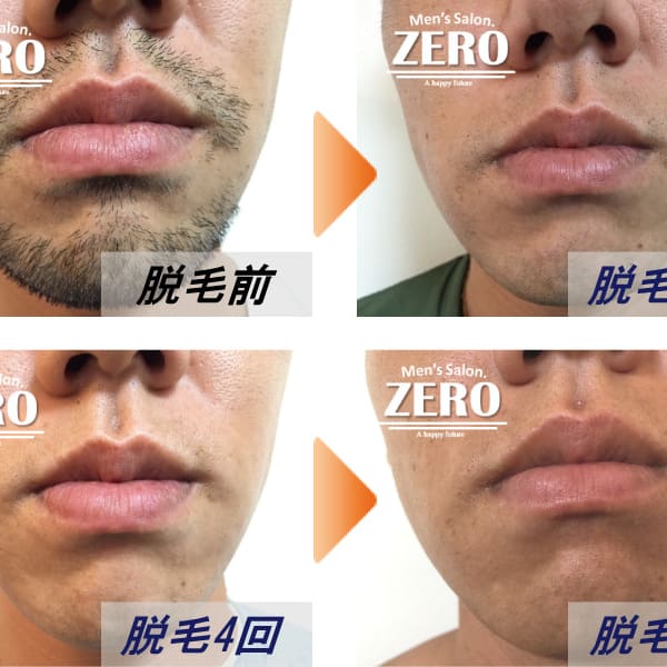 ZERO心斎橋【お客様脱毛写真】ヒゲ脱毛写真|Men's Salon ZERO心斎橋店