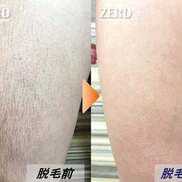 ZERO心斎橋【お客様脱毛写真】ボディ脱毛写真|Men's Salon ZERO心斎橋店