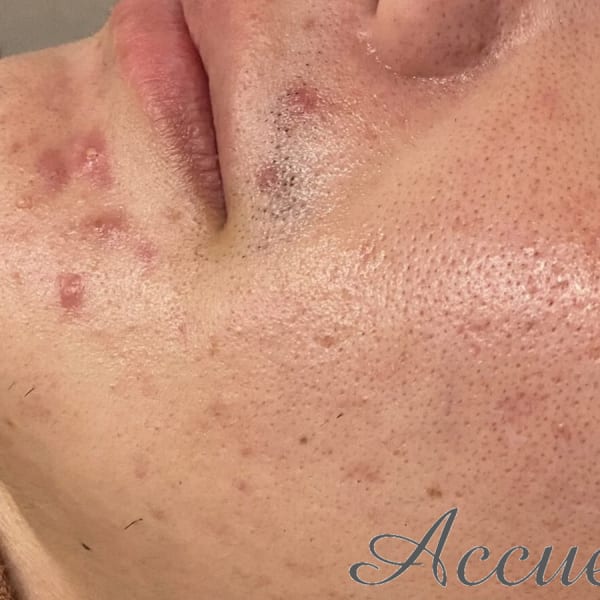 男性の肌トラブルを徹底改善！お一人お一人の肌質に合わせた施術でお悩み解決★お気軽にご相談ください♪|肌トラブル改善専門店 Accueil