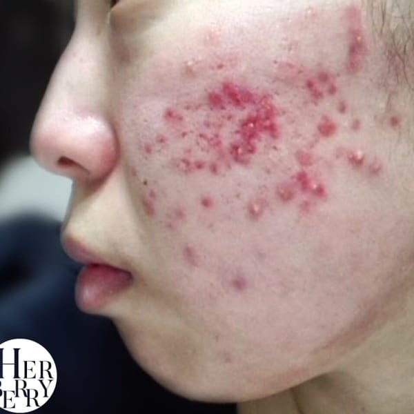 癒しの空間で♪お顔も体もハーブピーリング★ボディも人気です|ハーブピーリング専門店 HERBERRY