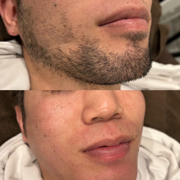 効果スピードで選ぶならCROWNに・・・|メンズ脱毛・レディース脱毛 都度払い脱毛サロン CROWN