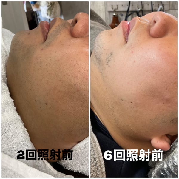 【カットと脱毛をワンセット☆】【毎日の髭剃りの肌荒れを軽減!!】|LiNK【リンク】