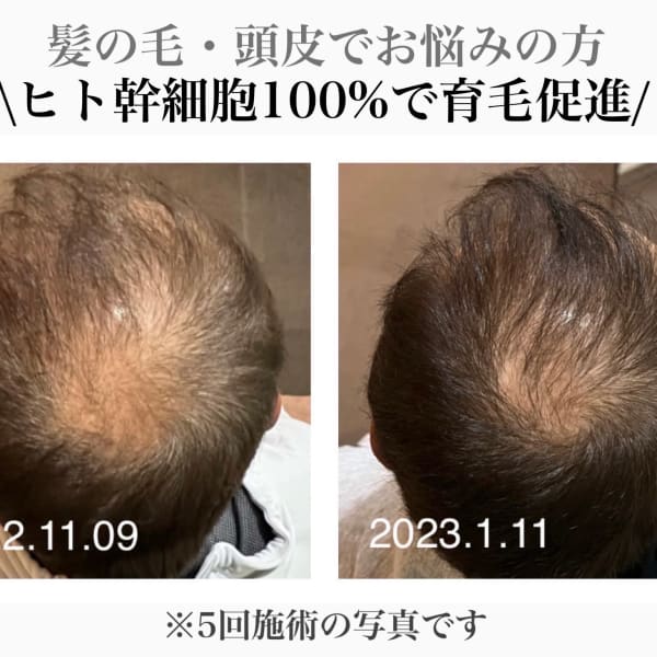 【強髪】【育毛促進】【ハリ・コシ・太く・強く】ヒト幹細胞であなたの未来の髪を守ります！|メンズ育毛/脱毛/フェイシャルサロンjoieange心斎橋店