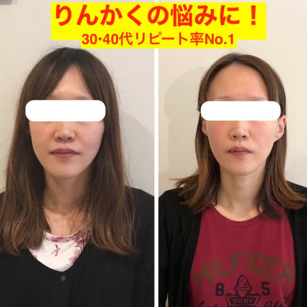 【小顔＆りんかく矯正】骨から変わるりんかく美人♫得意技は面長★への字口★目の上たるみ★輪郭たるみ|たるみ専門小顔矯正 サロンアリエス