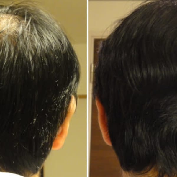 あきらめてませんか?もう薄毛はなくなる時代です。とりあえづ画像をタップしてご覧ください。|CROCO