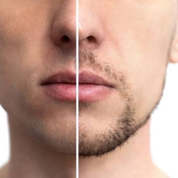 メンズ脱毛・ひげ脱毛・髭剃りによる肌荒れやニキビからも解放!ビジネスマンに人気!ツルツル肌で清潔感!|小顔コルギ・ハーブピーリング・脱毛・痩身・ CHARIS.T