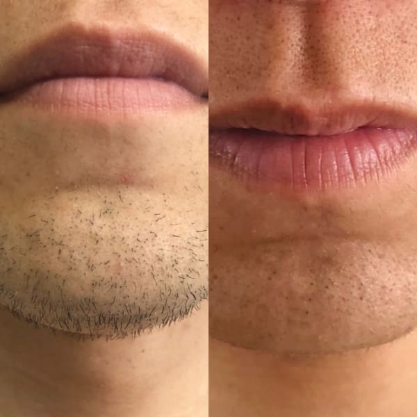 【make心斎橋店】ひげ脱毛の効果♪|make Total Beauty メンズ眉毛|眉毛サロン