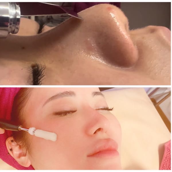 毛穴ケア、毛穴洗浄、引き締め、黒ずみなど毛穴のお悩みに！|ハーバルピール・フェイシャル専門 エステサロンJIJI新宿