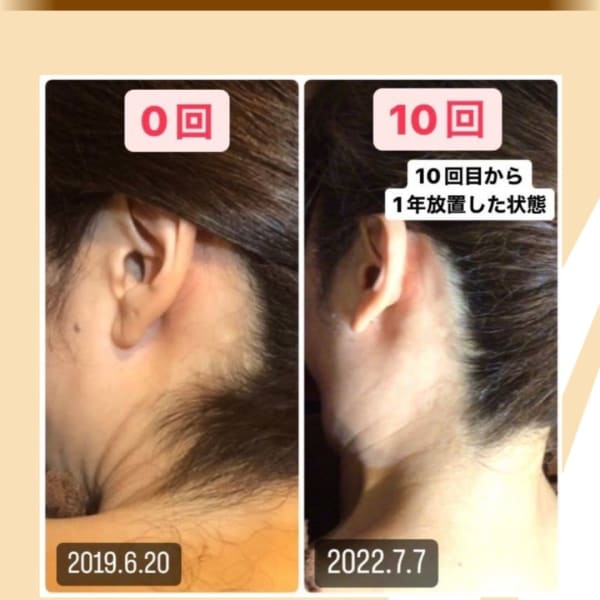 ハイスペック脱毛器で無痛脱毛♪|エステティックサロンCubia