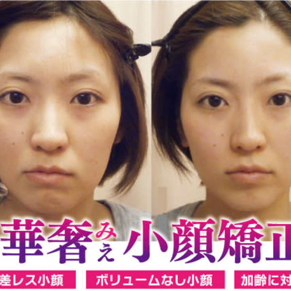 【顔の左右差をなくしたい！】|小顔（左右差）矯正・鎖骨出し矯正 専門院 Moreface
