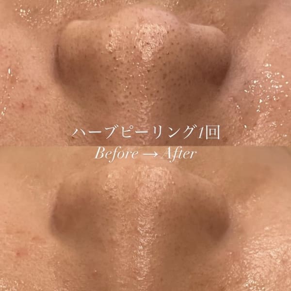 次世代ハーブピーリング!剥離なし!ダウンタイム無し!|メンズ脱毛フェイシャル専門店 joieange京橋