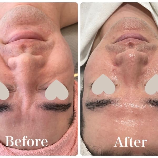 保湿と鎮静で一気に若返り!正しいスキンケアでサロンとお家ケアでダブルアタック!!|メンズ脱毛フェイシャル専門店 joieange京橋