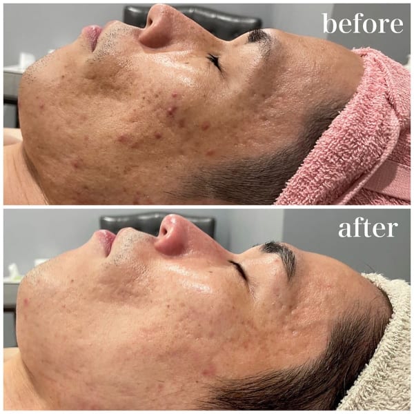 ニキビのもとから撃退!!殺菌、抗菌、鎮静でニキビ、ニキビ跡にもアプローチ|メンズ脱毛フェイシャル専門店 joieange京橋