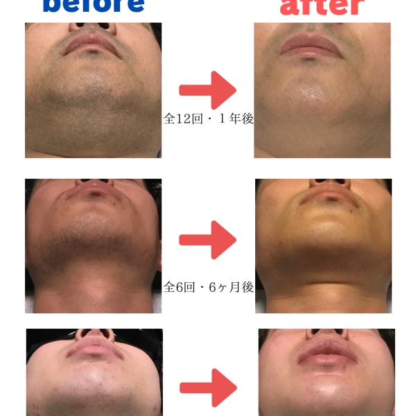 《人気・オススメ》ひげの脱毛で肌荒れの無い清潔感のある男性に!|【メンズヘアサロン】SiGN