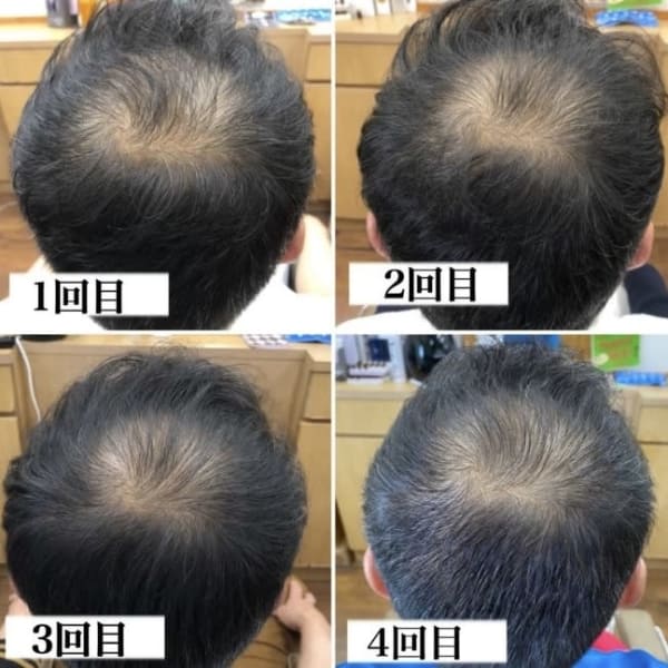 最先端のヒト幹細胞培養液＋高濃度エクソソームで頭皮環境と毛髪サイクルを整えハリツヤのある理想の髪へ★|脱毛＆痩身 GLYCINE