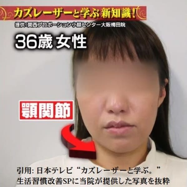顔の矯正・小顔対称矯正専門院。大阪梅田得意技は、顎・エラ・頬の非対称専門矯正です!|顔の歪み/小顔矯正 関西プロポーション小顔センター大阪梅田院