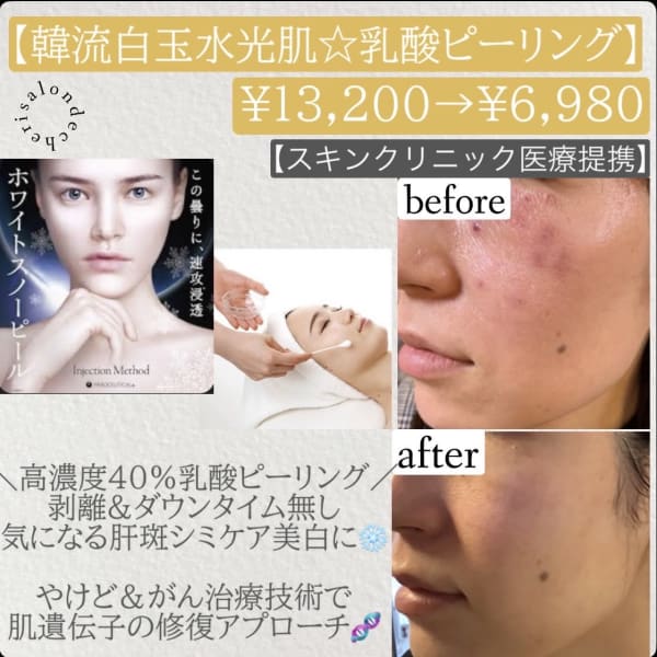 話題の韓流!憧れ白玉水光肌に☆高濃度40%乳酸ピーリングで徹底美白シミケア♪|メンズ専門 salon de cheri