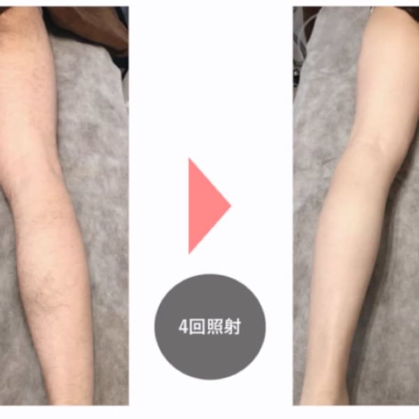 人気のvio脱毛!まとめてスッキリ下半身脱毛がお得♪|脱毛&痩身 GLYCINE