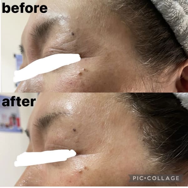 ホウレイ線・たるみ改善!予防ケア|【肌質改善】全身ハーブピーリング専門店 Lapeca~ラペカ~名古屋丸の内店