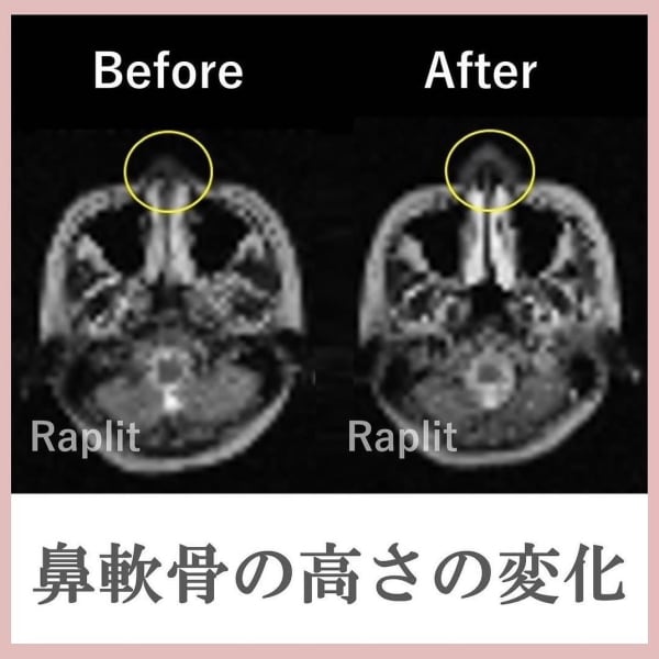 ビフォーアフター【MRI画像】|隆鼻矯正専門店 Raplit 福岡天神店　美鼻・小顔矯正・輪郭矯正