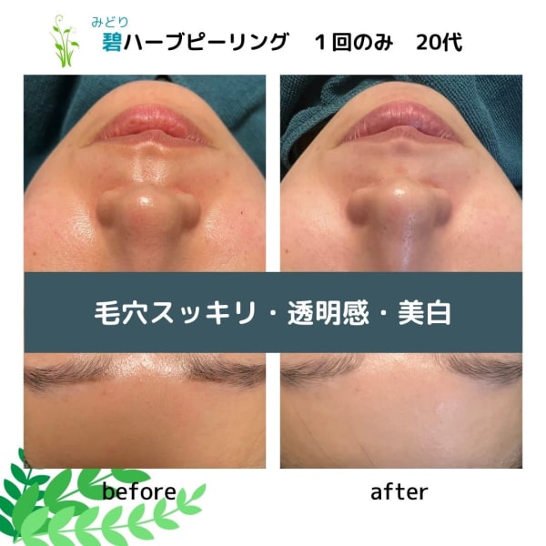 毛穴の黒ずみは川越のエステサロンカノン（Kanon）におまかせ！|total beauty salon Kanon